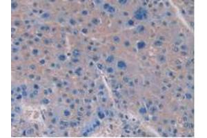 IHC-P analysis of Human Liver Cancer Tissue, with DAB staining. (IL-15 抗体  (AA 50-162))