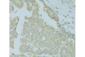 Immunohistochemistry of paraffin-embedded Human colon carcinoma using MTFP1 Polyclonal Antibody at dilution of 1:100 (40x lens). (Mtfp1 抗体)