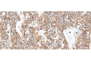 Immunohistochemistry of paraffin-embedded Human gastric cancer tissue using RNF111 Polyclonal Antibody at dilution of 1:50(x200) (RNF111 抗体)