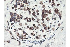 Immunohistochemical staining of paraffin-embedded Adenocarcinoma of Human colon tissue using anti-PFKP mouse monoclonal antibody. (PFKP 抗体)