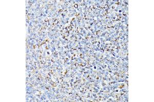 Immunohistochemistry of paraffin-embedded Human lymph node tumors using TP53I11 antibody (ABIN6131365, ABIN6149418, ABIN6149419 and ABIN6216636) at dilution of 1:100 (40x lens). (TP53I11 抗体  (AA 1-70))