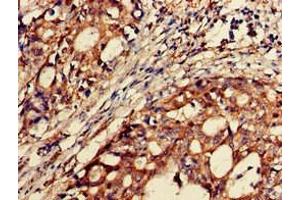 Immunohistochemistry of paraffin-embedded human gastric cancer using ABIN7145535 at dilution of 1:100 (BACE2 抗体  (AA 84-157))