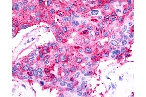 Anti-TPRA1 / GPR175 antibody IHC of human Breast, Carcinoma. (GPR175 抗体  (Cytoplasmic Domain))