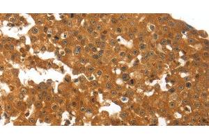 Immunohistochemistry of paraffin-embedded Human breast cancer using TNFRSF11B Polyclonal Antibody at dilution of 1:30 (Osteoprotegerin 抗体)