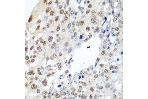 Immunohistochemistry of paraffin-embedded human lung cancer using PTTG1 antibody. (PTTG1 抗体  (AA 1-202))