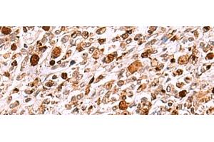 Immunohistochemistry of paraffin-embedded Human gastric cancer tissue using INO80 Polyclonal Antibody at dilution of 1:85(x200) (INO80 抗体)