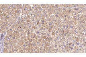 ABIN6272654 at 1/100 staining Human Melanoma tissue by IHC-P. (PSG3 抗体)