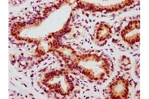 IHC image of ABIN7127704 diluted at 1:100 and staining in paraffin-embedded human breast cancer performed on a Leica BondTM system. (Recombinant C-JUN 抗体  (pSer63))