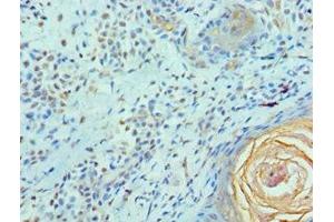 Immunohistochemistry of paraffin-embedded human breast cancer using ABIN7152098 at dilution of 1:100 (Elf4 抗体  (AA 1-200))