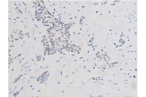 ABIN6267524 at 1/200 staining Human bladder cancer tissue sections by IHC-P. (SYK 抗体  (pTyr525))