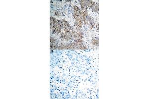 Immunohistochemical staining of human breast cancer tissue by IGF1R (phospho Y1161) polyclonal antibody  without blocking peptide (A) or preincubated with blocking peptide (B) under 1:50-1:100 dilution. (IGF1R 抗体  (pTyr1161))