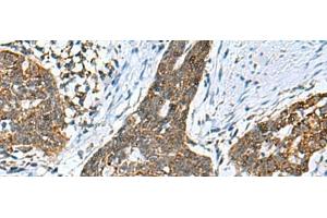 Immunohistochemistry of paraffin-embedded Human esophagus cancer tissue using PREPL Polyclonal Antibody at dilution of 1:55(x200) (PREPL 抗体)