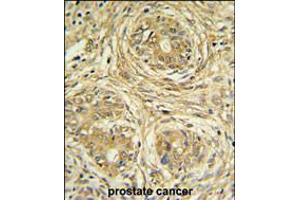 SUPV3L1 Antibody IHC analysis in formalin fixed and paraffin embedded prostate carcinoma followed by peroxidase conjugation of the secondary antibody and DAB staining.