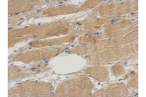 IHC-P Image Immunohistochemical analysis of paraffin-embedded human gastric cancer, using Septin 2, antibody at 1:500 dilution. (Septin 2 抗体)