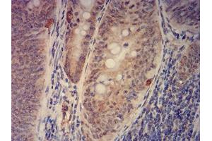 Immunohistochemical analysis of paraffin-embedded rectum cancer tissues using KAT2B mouse mAb with DAB staining. (KAT2B 抗体  (AA 1-142))