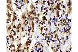 Immunohistochemistry analysis of paraffin-embedded human lymphoma using S100A4 Monoclonal Antibody at dilution of 1:300. (s100a4 抗体)