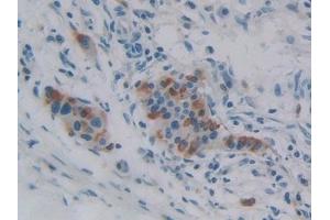 Detection of iPLA2 in Human Pancreatic cancer Tissue using Polyclonal Antibody to Phospholipase A2, Calcium Independent (iPLA2) (PNPLA2 抗体  (AA 484-701))