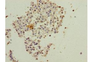 Immunohistochemistry of paraffin-embedded human breast cancer using ABIN7150890 at dilution of 1:100 (DNAL4 抗体  (AA 1-105))