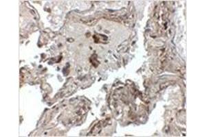 Immunohistochemistry of Transthyretin in human lung tissue with Transthyretin antibody at 2. (TTR 抗体  (Center))