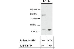 WB of IL-1-Ra of total plasma protein in a native, gradient gel under non-reducing conditions of patient MIS-C-I at presentation with acute inflammation and seropositive for IL-1-Ra-Abs of IgG class and 7 months later without IL-1-Ra-Abs.