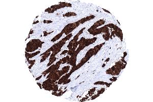 Muscle invasive urothelial carcinoma of the urinary bladder showing a strong S100P immunostaining of tumor cells (Recombinant S100P 抗体  (C-Term))