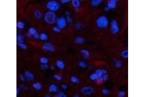 Immunofluorescence analysis of Human liver cancer tissue using TTR Monoclonal Antibody at dilution of 1:200. (TTR 抗体)