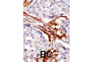 Formalin-fixed and paraffin-embedded human cancer tissue reacted with YES1 polyclonal antibody  , which was peroxidase-conjugated to the secondary antibody, followed by AEC staining. (YES1 抗体  (N-Term))