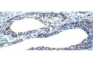 Immunohistochemistry of paraffin-embedded Human cervical cancer tissue using IRF5 Polyclonal Antibody at dilution of 1:25(x200) (IRF5 抗体)