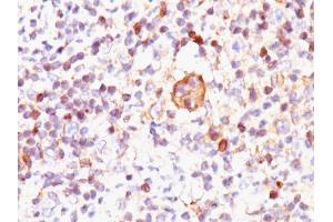 Formalin-fixed, paraffin-embedded human Hodgkin's Lymphoma stained with Bax Mouse Monoclonal Antibody (2D2).