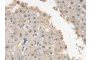 Detection of CRP in Human Liver cancer Tissue using Polyclonal Antibody to C Reactive Protein (CRP) (CRP 抗体  (AA 17-224))