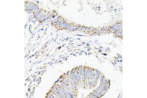 Immunohistochemistry of paraffin-embedded human colon carcinoma using SDC2 antibody at dilution of 1:100 (x40 lens). (Syndecan 2 抗体)