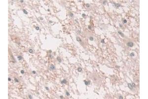 Detection of NCOA3 in Human Glioma Tissue using Polyclonal Antibody to Nuclear Receptor Coactivator 3 (NCOA3)