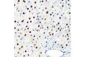 Immunohistochemistry of paraffin-embedded human liver cancer using SSB antibody at dilution of 1:100 (40x lens). (SSB 抗体)