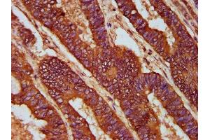 IHC image of ABIN7147135 diluted at 1:200 and staining in paraffin-embedded human colon cancer performed on a Leica BondTM system. (CD2AP 抗体  (AA 333-426))