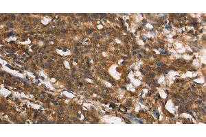 Immunohistochemistry of paraffin-embedded Human gastic cancer using MARC1 Polyclonal Antibody at dilution of 1:40 (MOSC1 抗体)