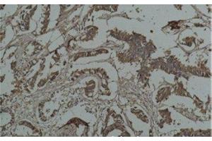 Immunohistochemistry of paraffin-embedded Human breast carcinoma tissue using HSP27 Monoclonal Antibody at dilution of 1:200.
