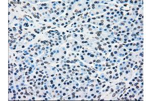 Immunohistochemical staining of paraffin-embedded Adenocarcinoma of breast tissue using anti-BRAF mouse monoclonal antibody. (BRAF 抗体)