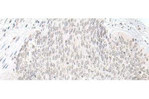 Immunohistochemistry of paraffin-embedded Human esophagus cancer tissue using ORC1 Polyclonal Antibody at dilution of 1:65(x200) (ORC1 抗体)