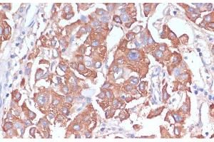 Immunohistochemistry of paraffin-embedded Human liver cancer using LRP1 Polyclonal Antibody at dilution of 1:100 (40x lens). (LRP1 抗体)