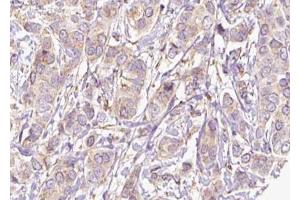 ABIN6273812 at 1/100 staining Human breast cancer tissue by IHC-P.
