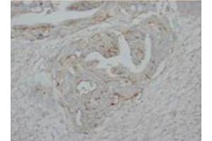 Immunohistochemical analysis of paraffin embedded HUman intestine cancer sections using P73alpha antibody (Tumor Protein p73 抗体  (C-Term))