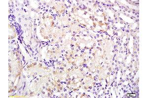 Formalin-fixed and paraffin embedded human laryngeal carcinoma labeled with Anti-FPR1 Polyclonal Antibody, Unconjugated (ABIN742245) at 1:200 followed by conjugation to the secondary antibody and DAB staining (FPR1 抗体)