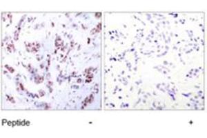 Immunohistochemical analysis of paraffin-embedded human breast carcinoma tissue using MEF2A polyclonal antibody  . (MEF2A 抗体)