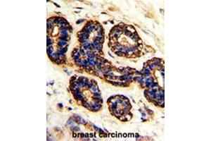 Formalin-fixed and paraffin-embedded human breast carcinoma with BEST2 Antibody (C-term), which was peroxidase-conjugated to the secondary antibody, followed by DAB staining. (Bestrophin 2 抗体  (C-Term))