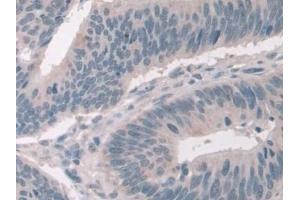 Detection of NCOA3 in Human Colorectal cancer Tissue using Polyclonal Antibody to Nuclear Receptor Coactivator 3 (NCOA3) (NCOA3 抗体  (AA 1023-1304))