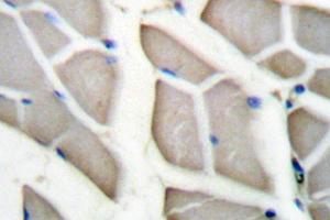 Immunohistochemistry (IHC) analyzes of 14-3-3 ζ (pVal52) antibody in paraffin-embedded human breast carcinoma tissue. (14-3-3 zeta 抗体)