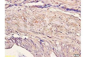 Formalin-fixed and paraffin embedded human colon carcinoma with Anti-Pokemon Polyclonal Antibody, Unconjugated (ABIN729448) at 1:200, followed by conjugation to the secondary antibody and DAB staining (ZBTB7A 抗体  (AA 151-250))