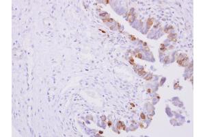 IHC-P Image POR antibody detects POR protein at cytoplasm on human ovarian carcinoma by immunohistochemical analysis. (POR 抗体  (N-Term))