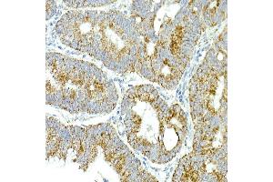 Immunohistochemistry of paraffin-embedded human colon carcinoma using MRPS15 Rabbit mAb (ABIN7268582) at dilution of 1:250 (40x lens). (MRPS15 抗体)