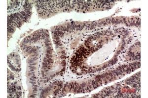 Immunohistochemistry (IHC) analysis of paraffin-embedded Human Colon Cancer, antibody was diluted at 1:100. (Histone H2A 抗体  (Internal Region))